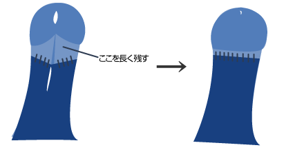 亀頭直下切除法