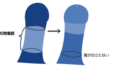 陰茎根部切除法