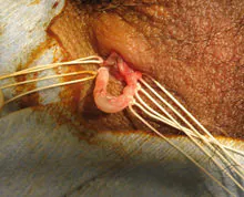精管を結紮後、精管を切除する